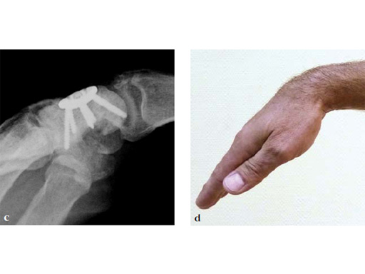 2-4-VA-Locking-Intercarpal-Fusion-System-23