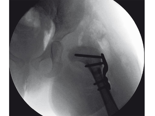 27-2-7-LCP-Pediatric-Hip-Plate-06