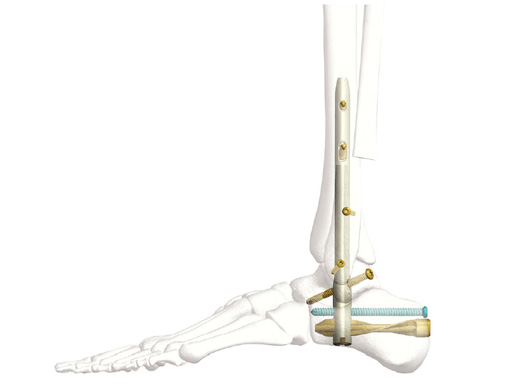 29-Hindfoot-Arthrodesis-Nail-HAN-01