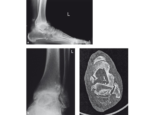 29-Hindfoot-Arthrodesis-Nail-HAN-03