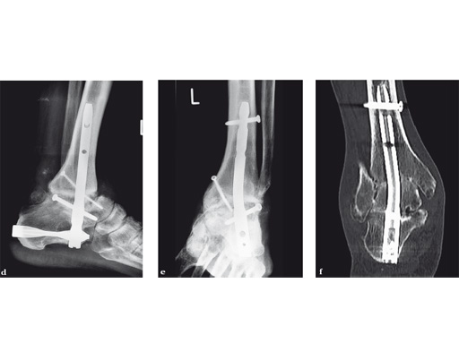 29-Hindfoot-Arthrodesis-Nail-HAN-04