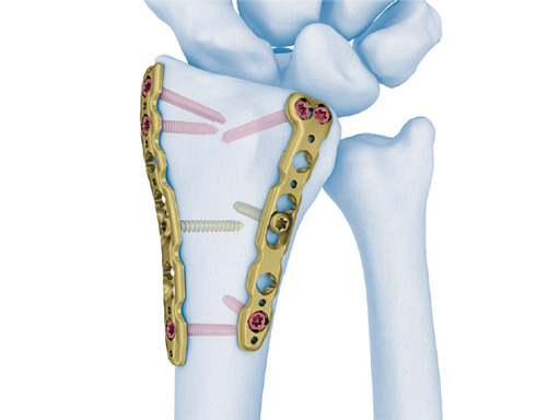 2_4-VA-LCP-Dorsal-Distal-Radius-Plate-01