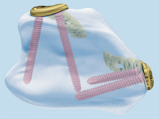 2_4-VA-LCP-Dorsal-Distal-Radius-Plate-02