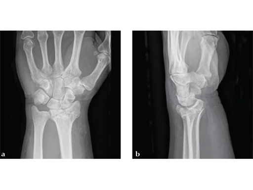 2_4-VA-LCP-Dorsal-Distal-Radius-Plate-04