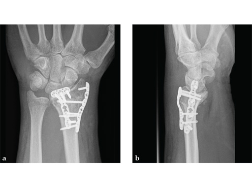 2_4-VA-LCP-Dorsal-Distal-Radius-Plate-07