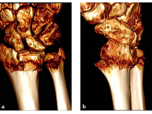 2_4-VA-LCP-Dorsal-Distal-Radius-Plate-09