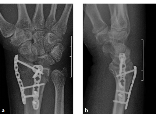 2_4-VA-LCP-Dorsal-Distal-Radius-Plate-10