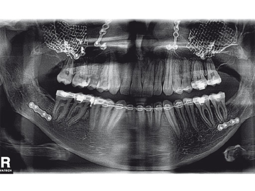 34-sterile-artificial-skull-04