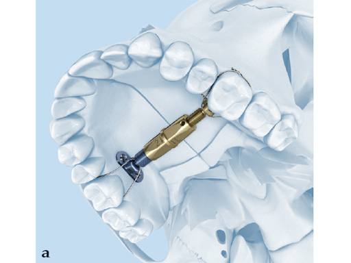 38-Transpalatal-Distractor-system-01