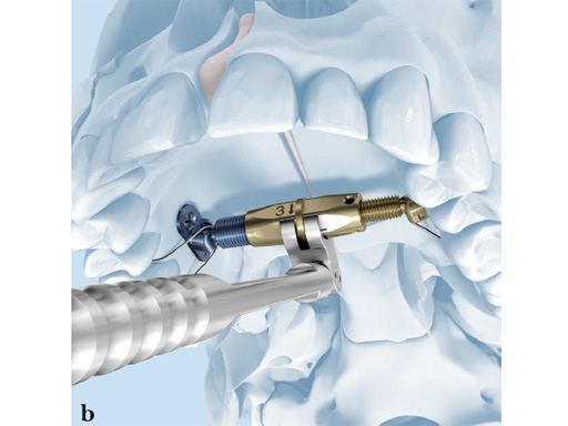 38-Transpalatal-Distractor-system-02