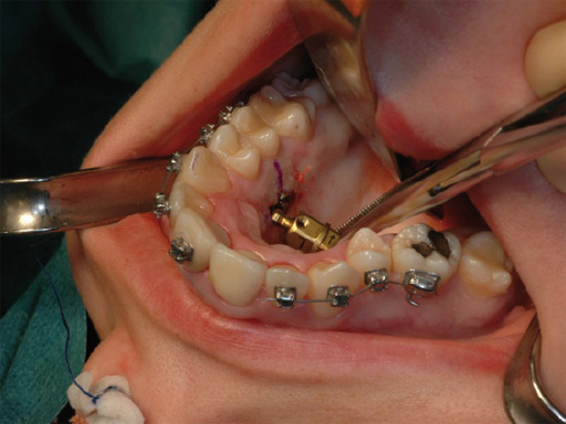 38-Transpalatal-Distractor-system-08