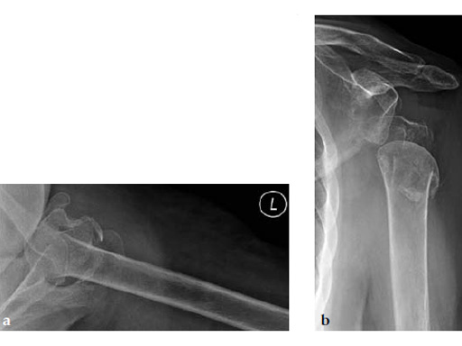 3_5-LCP-Periarticular-Proximal-Humerus-02