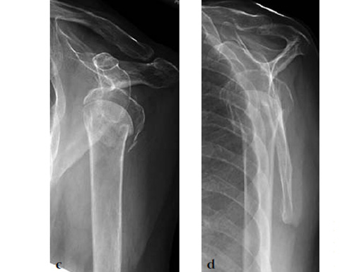 3_5-LCP-Periarticular-Proximal-Humerus-03