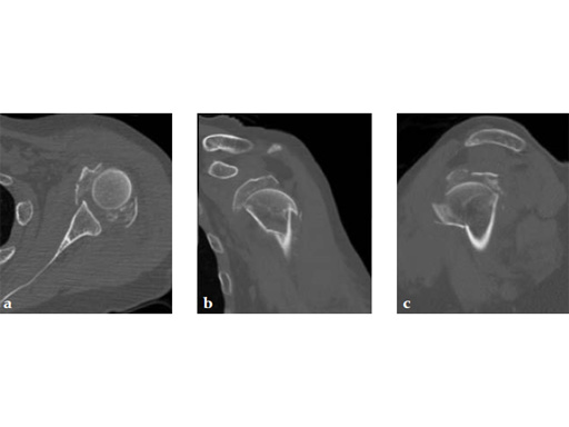 3_5-LCP-Periarticular-Proximal-Humerus-04