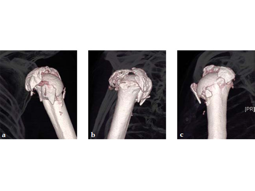 3_5-LCP-Periarticular-Proximal-Humerus-05