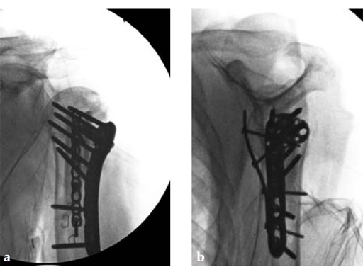 3_5-LCP-Periarticular-Proximal-Humerus-06