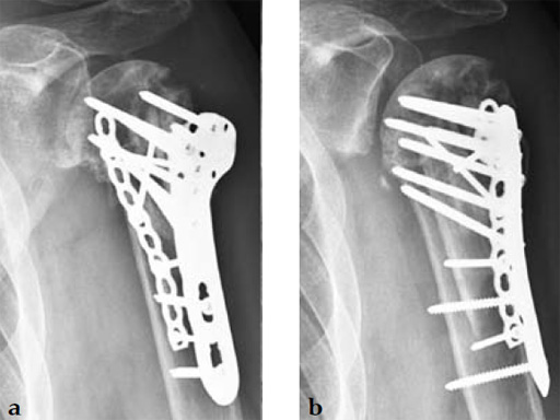 3_5-LCP-Periarticular-Proximal-Humerus-07