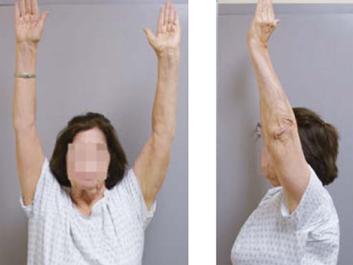 3_5-LCP-Periarticular-Proximal-Humerus-08