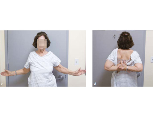 3_5-LCP-Periarticular-Proximal-Humerus-09