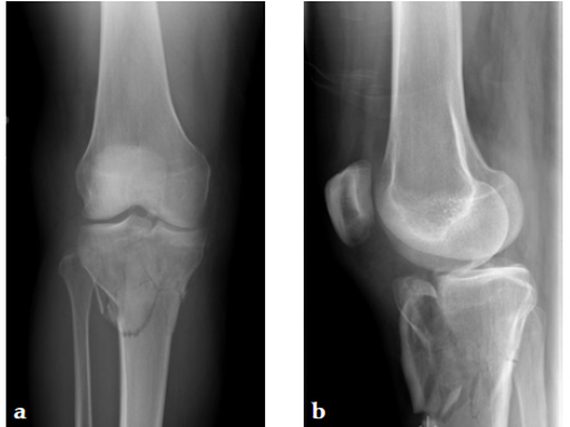 3_5-LCP-Proximal-Tibia-Low-Bend-03