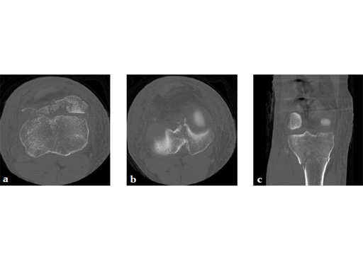 3_5-LCP-Proximal-Tibia-Low-Bend-04