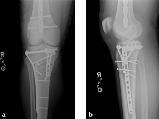 3_5-LCP-Proximal-Tibia-Low-Bend-07