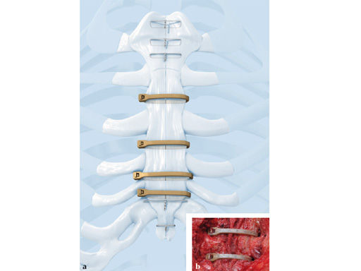 42-Sternal-Zipfix-System-01