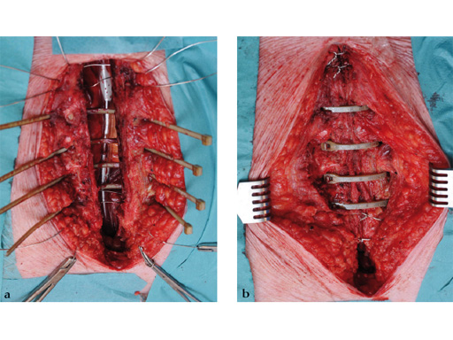 42-Sternal-Zipfix-System-02