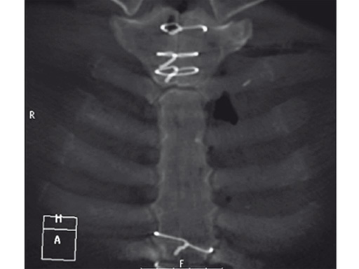 42-Sternal-Zipfix-System-03