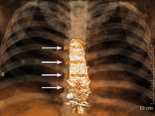 42-Sternal-Zipfix-System-04