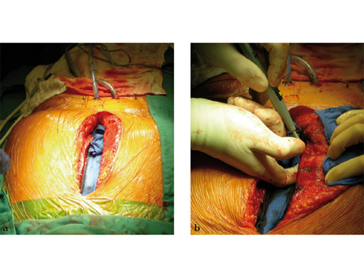 42-Sternal-Zipfix-System-05