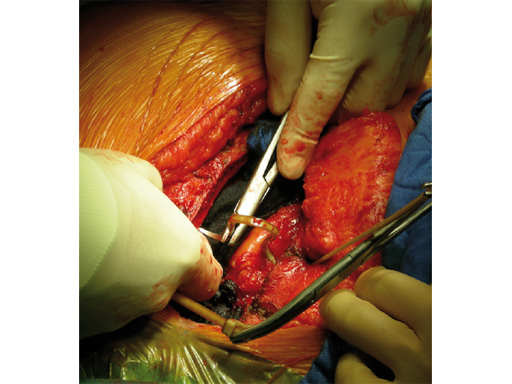 42-Sternal-Zipfix-System-06