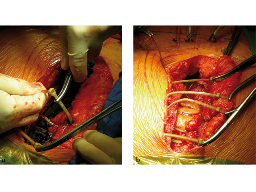 42-Sternal-Zipfix-System-07