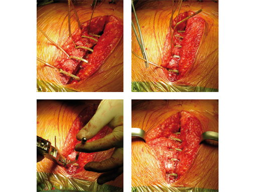 42-Sternal-Zipfix-System-08