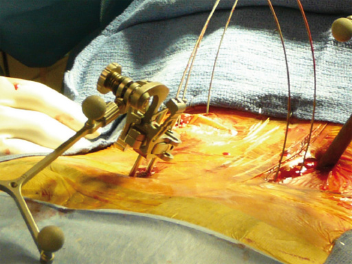 46-Matrix-Deformity-Matrix-MIS-02