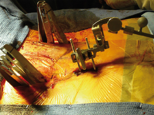 46-Matrix-Deformity-Matrix-MIS-03