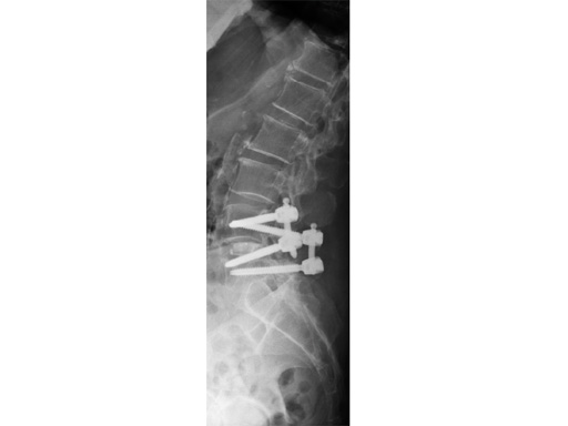 46-Matrix-Deformity-Matrix-MIS-04