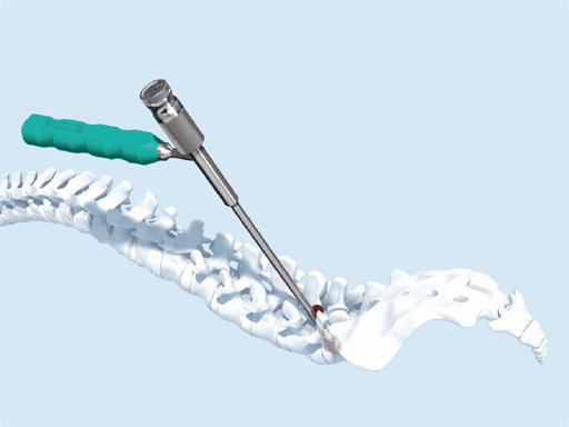 50-OPAP-Spacer-System-01