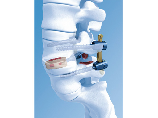 50-OPAP-Spacer-System-02