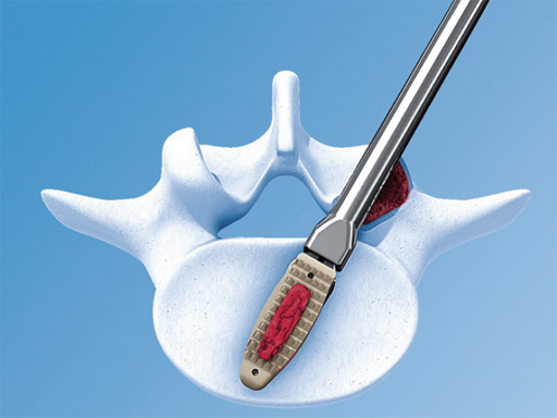 50-OPAP-Spacer-System-03