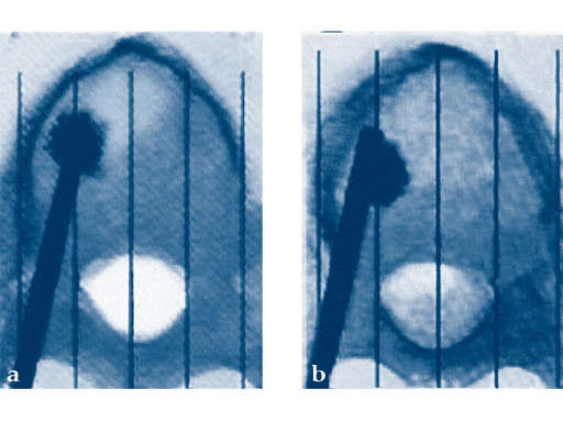 51-VBS-Stentoplasty-Vertecem-01