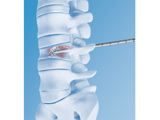 51-VBS-Stentoplasty-Vertecem-02