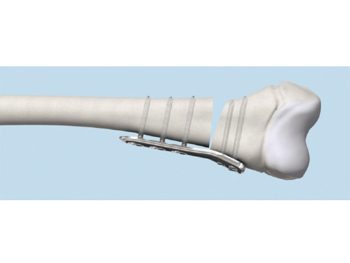 90-3_5-5-0-LCP-Pediatric-Condylar-Plate-02