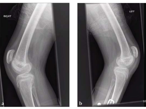 90-3_5-5-0-LCP-Pediatric-Condylar-Plate-03
