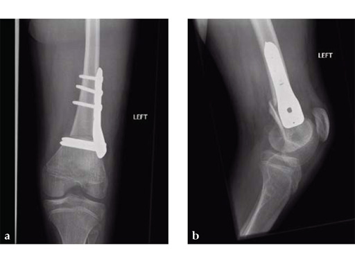 90-3_5-5-0-LCP-Pediatric-Condylar-Plate-04