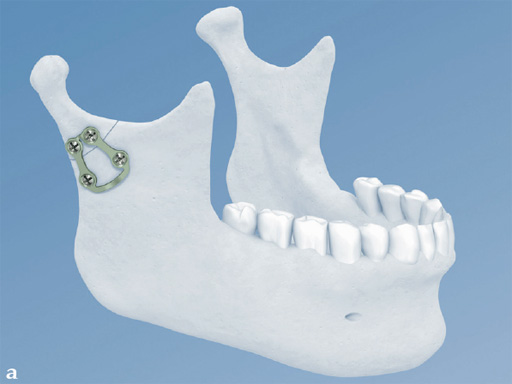 Fracture-Plates-Condylar-Neck-Base-02