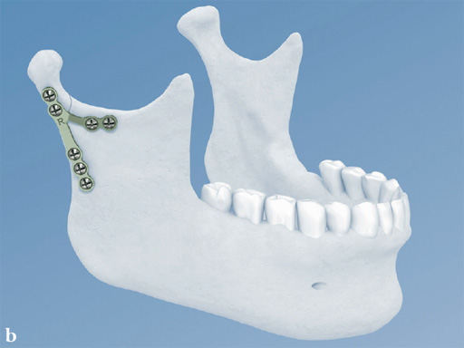 Fracture-Plates-Condylar-Neck-Base-03