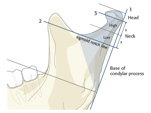 Fracture-Plates-Condylar-Neck-Base-04