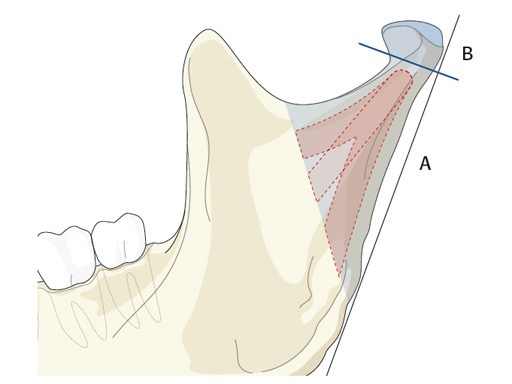Fracture-Plates-Condylar-Neck-Base-05