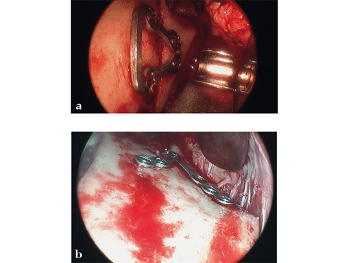 Fracture-Plates-Condylar-Neck-Base-06